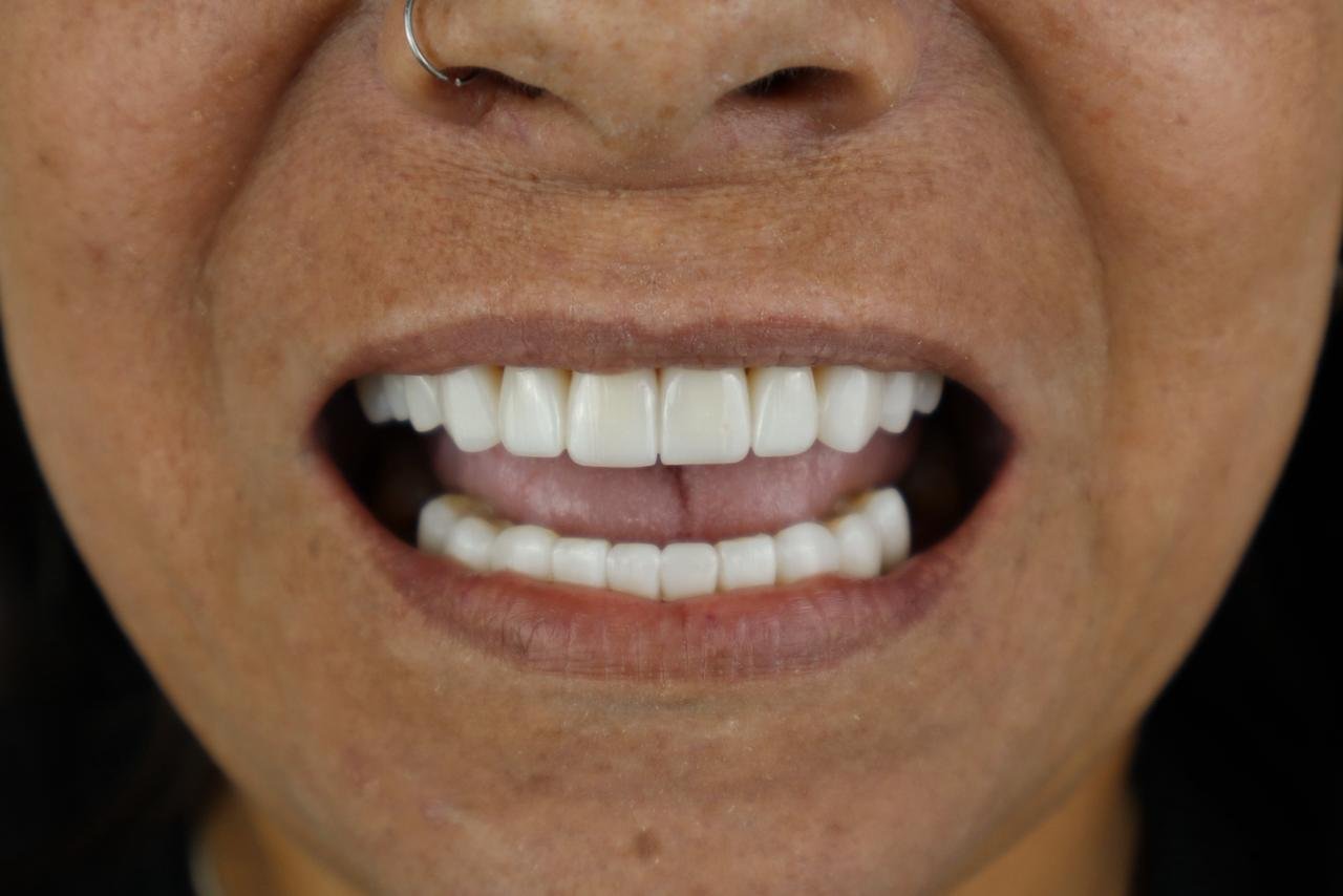Depois de lentes em resina do caso 2