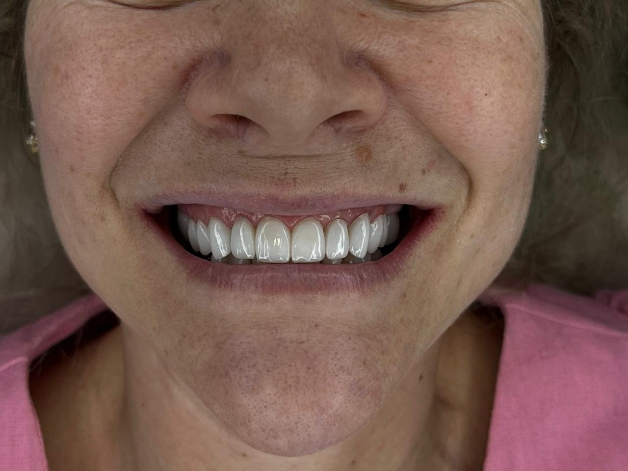 Depois de lentes em resina do caso feminino