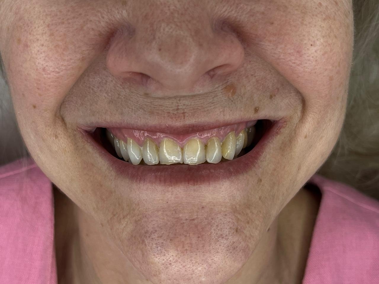 Antes de lentes em resina do caso feminino
