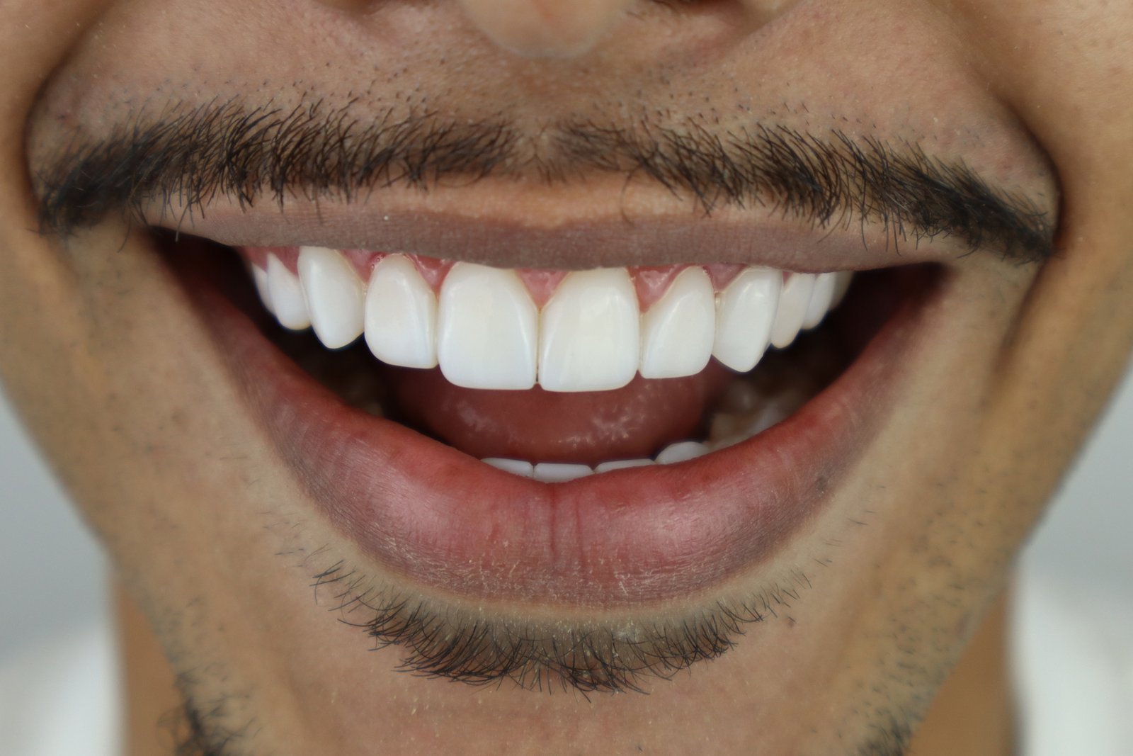 Sorriso transformado com acabamento natural