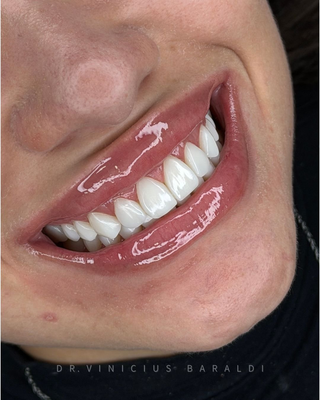 Resultado final de lentes em resina com sorriso e lábios em destaque