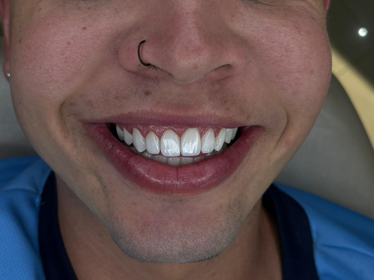 Resultado estético masculino com sorriso natural